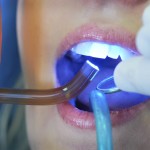 8. Dental Fillings 2