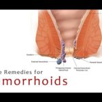 home remedies for hemorrhoids